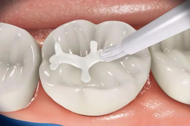 关于窝沟封闭的科普知识和操作手法都在这里！