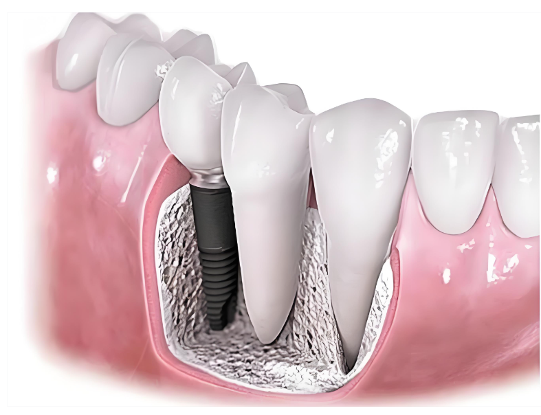 种植牙人类的第三副牙齿流程是什么？种植牙一、二、三期手术内容又是什么？【科普】